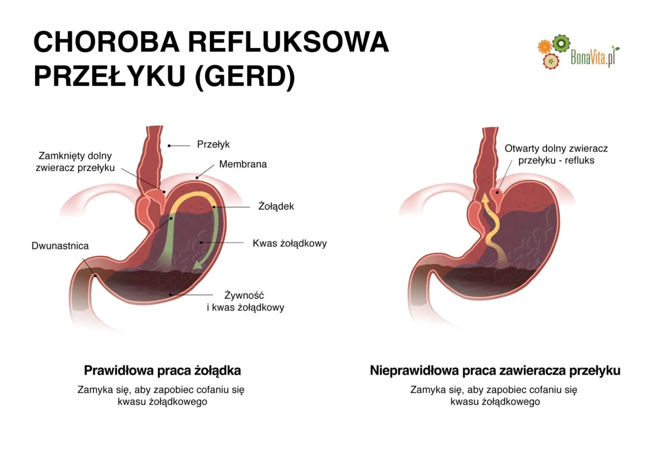 Dieta na refluks: Skuteczne zasady i jadłospis dla Twojej ulgi