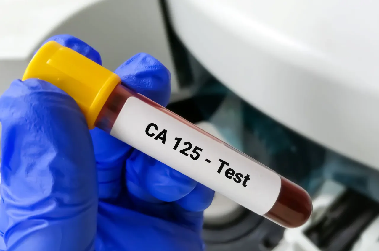 CA 125 - co to za badanie? Czy podwyższony wynik to rak?