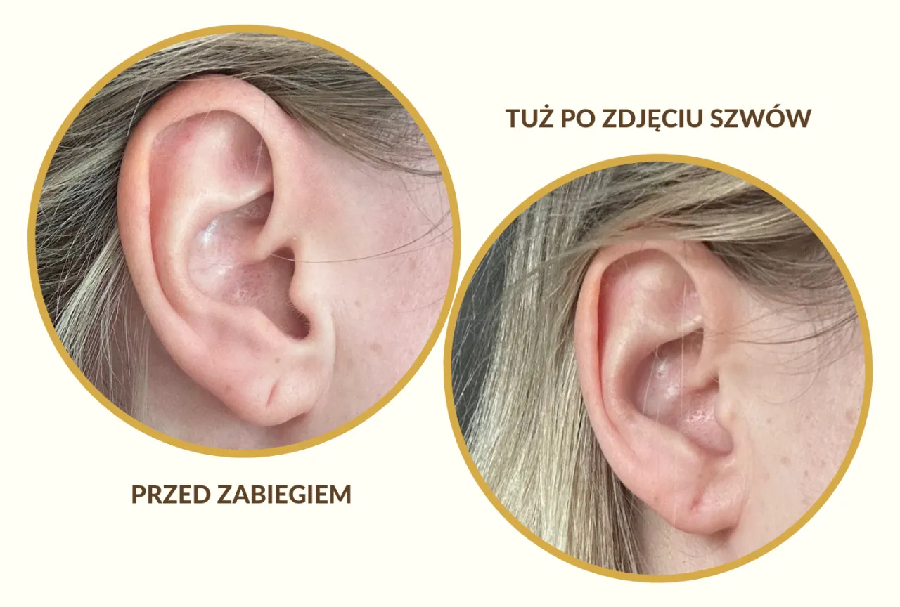 Druga dziurka w uchu: Przewodnik po zabiegu, gojeniu i stylizacji