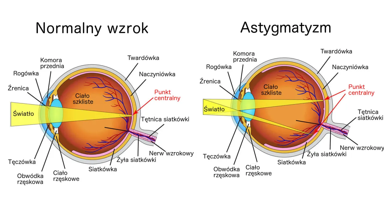 Astygmatyzm się powiększa? Jak kontrolować progresję wady Astygmatyzm się powiększa? Jak kontrolować progresję wady
