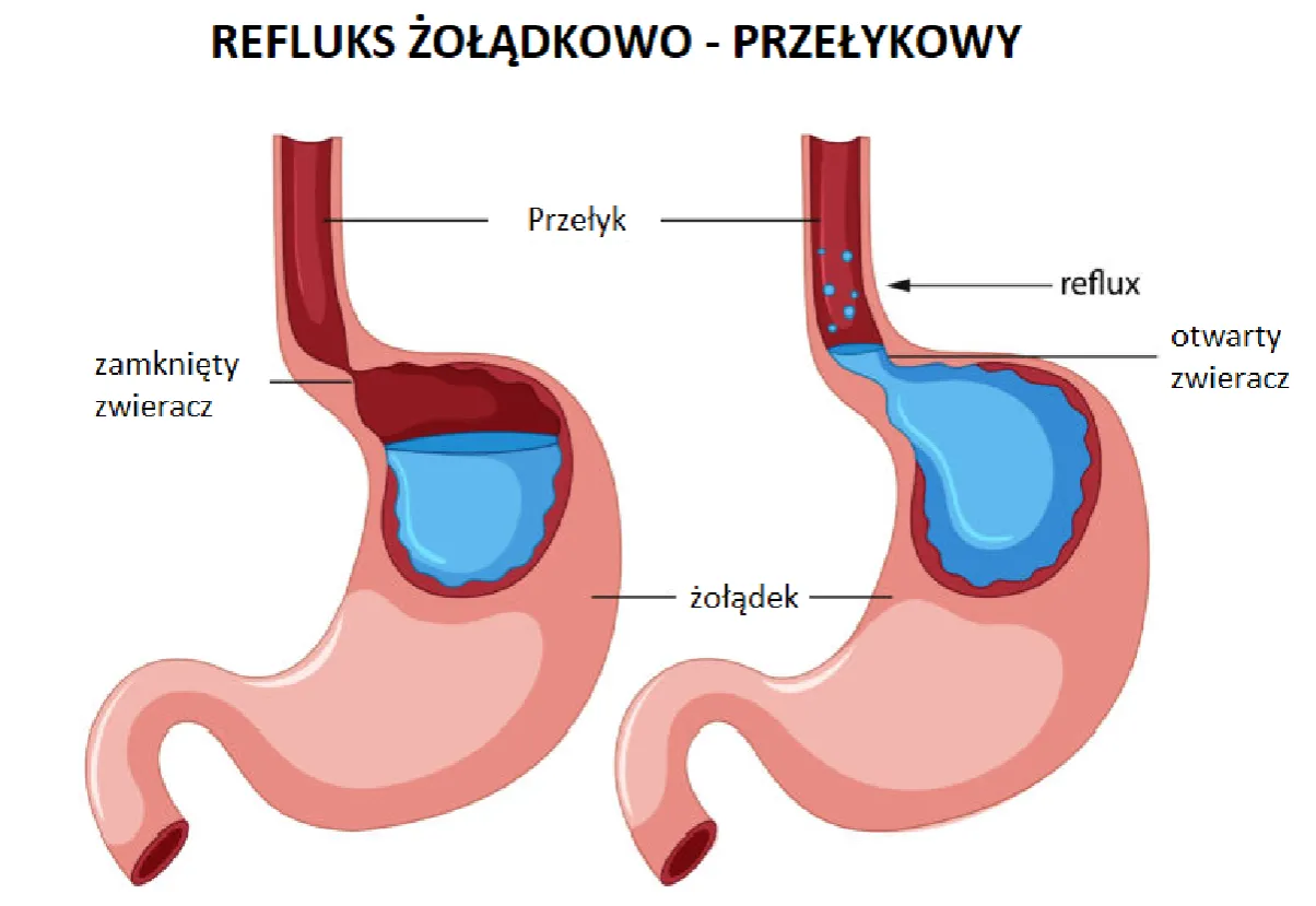 Refluks żołądkowo-przełykowy - jak rozpoznać objawy i co pomaga?