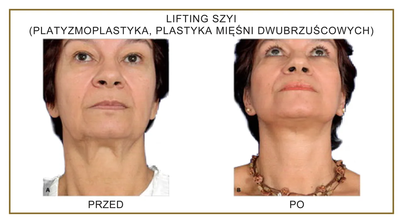 Lifting szyi - operacja, botoks czy nici? Sprawdź, co naprawdę działa Lifting szyi - operacja, botoks czy nici? Sprawdź, co naprawdę działa