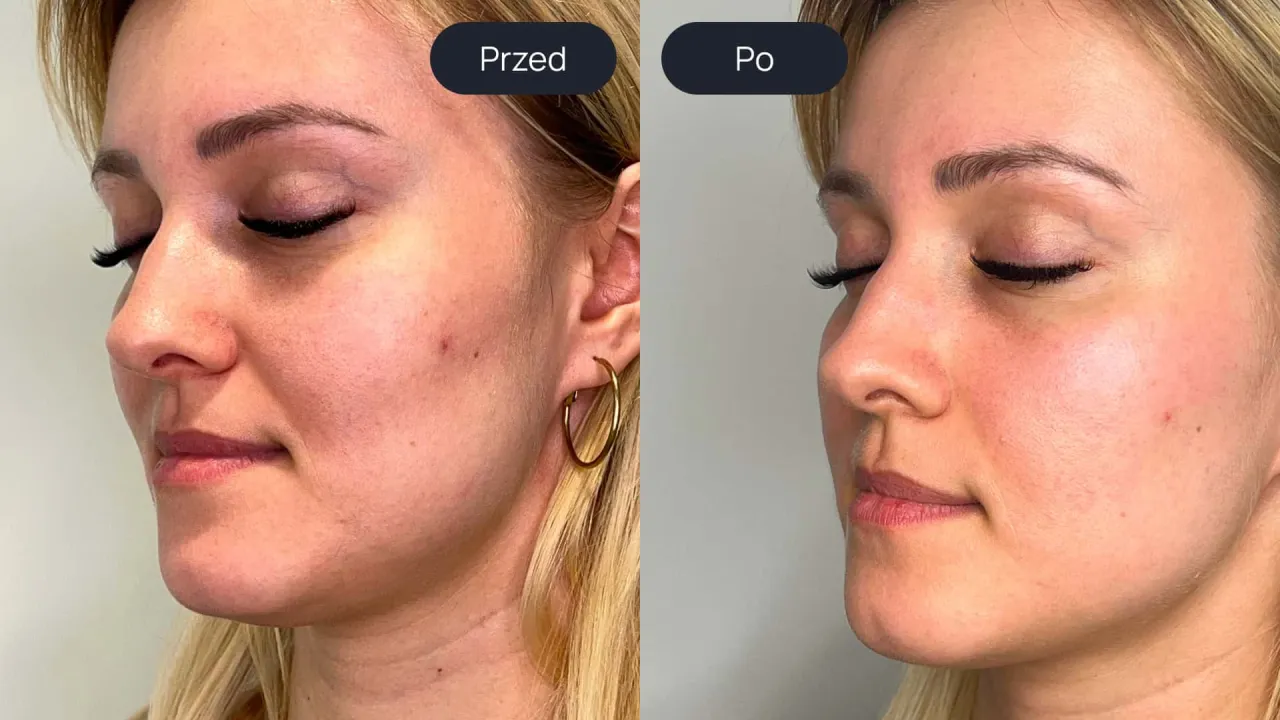 Laser tulowy efekty - Czego realnie oczekiwać po zabiegu?